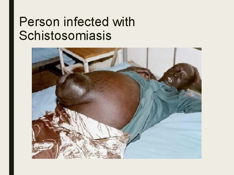 Person infected with Schistosomiasis 