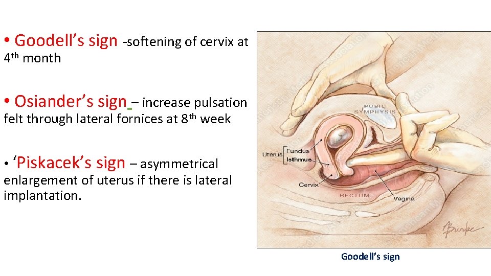 • Goodell’s sign -softening of cervix at 4 th month • Osiander’s sign • Goodell’s sign -softening of cervix at 4 th month • Osiander’s sign