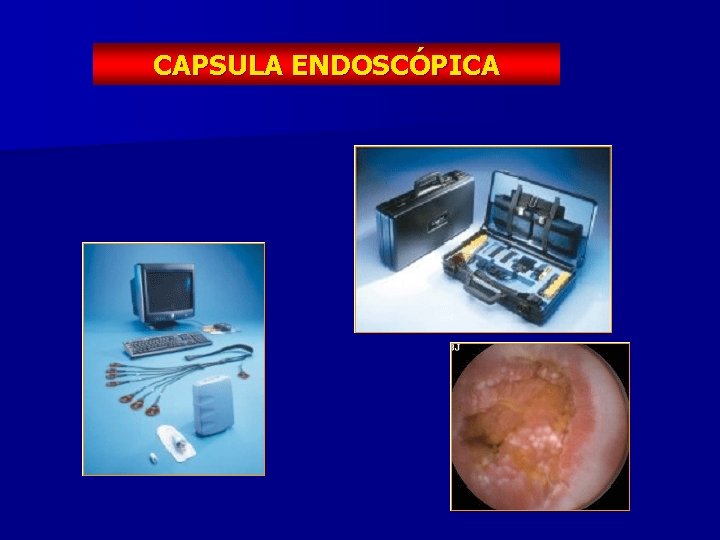 CAPSULA ENDOSCÓPICA 