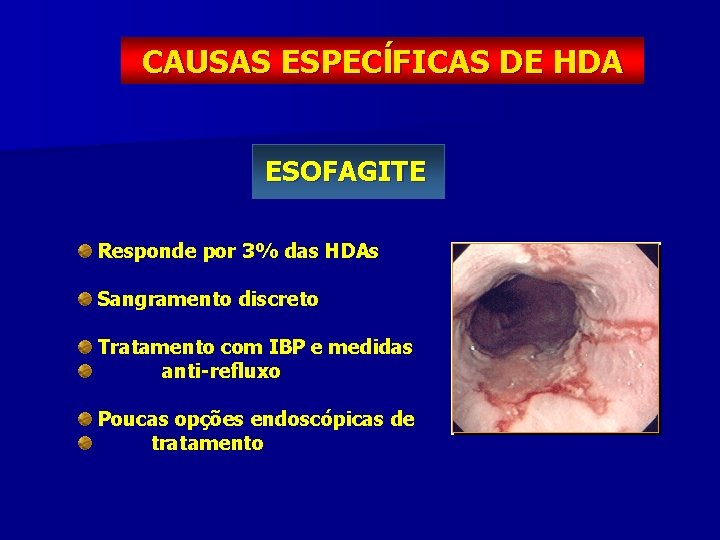 CAUSAS ESPECĺFICAS DE HDA ESOFAGITE Responde por 3% das HDAs Sangramento discreto Tratamento com