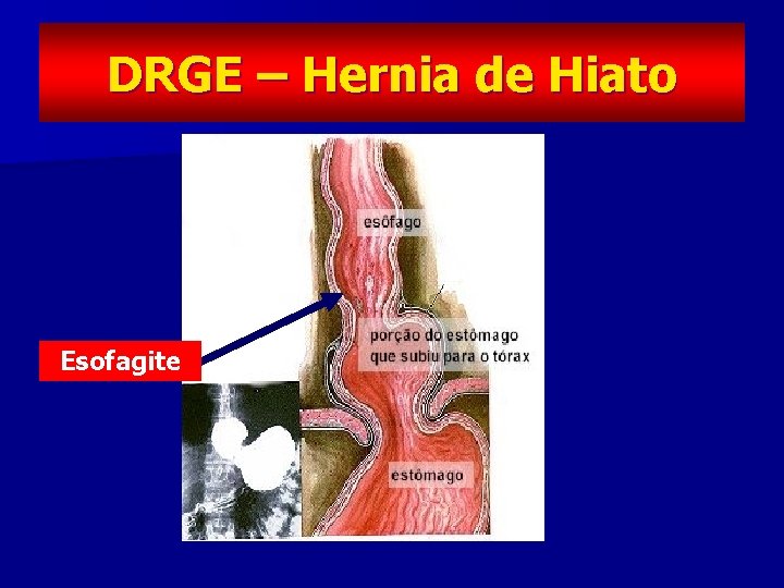 DRGE – Hernia de Hiato Esofagite 