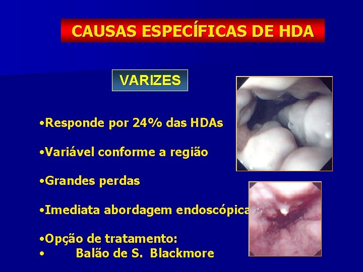 CAUSAS ESPECĺFICAS DE HDA VARIZES • Responde por 24% das HDAs • Variável conforme