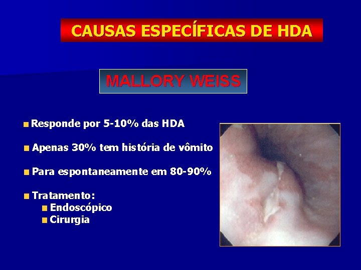 CAUSAS ESPECĺFICAS DE HDA MALLORY WEISS Responde por 5 -10% das HDA Apenas 30%