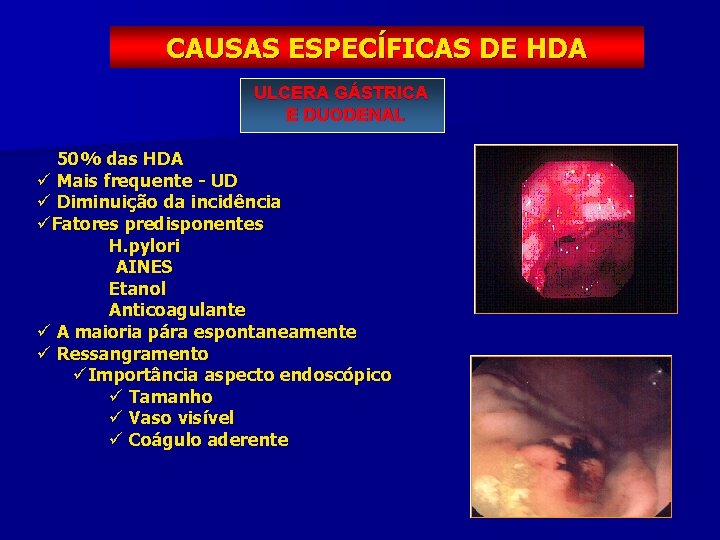 CAUSAS ESPECĺFICAS DE HDA ULCERA GÁSTRICA E DUODENAL ü 50% das HDA ü Mais