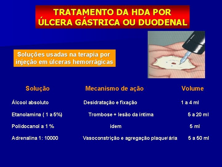 TRATAMENTO DA HDA POR ÚLCERA GÁSTRICA OU DUODENAL Soluções usadas na terapia por injeção