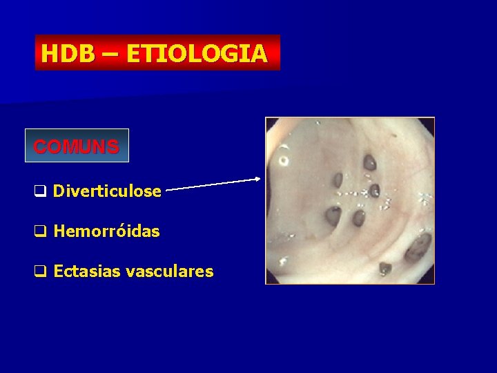 HDB – ETIOLOGIA COMUNS q Diverticulose q Hemorróidas q Ectasias vasculares 
