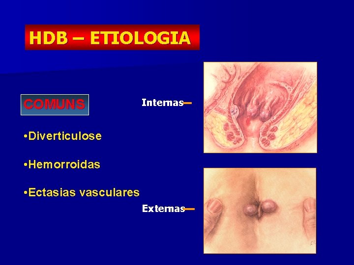 HDB – ETIOLOGIA COMUNS Internas • Diverticulose • Hemorroidas • Ectasias vasculares Externas 