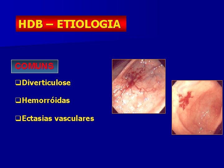 HDB – ETIOLOGIA COMUNS q. Diverticulose q. Hemorróidas q. Ectasias vasculares 