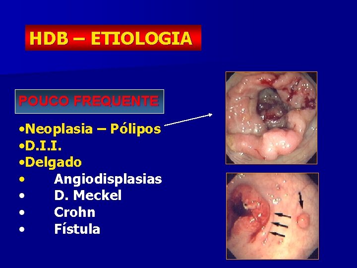 HDB – ETIOLOGIA POUCO FREQUENTE • Neoplasia – Pólipos • D. I. I. •