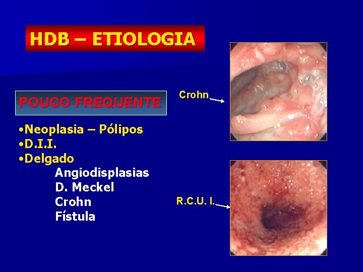 HDB – ETIOLOGIA POUCO FREQUENTE • Neoplasia – Pólipos • D. I. I. •