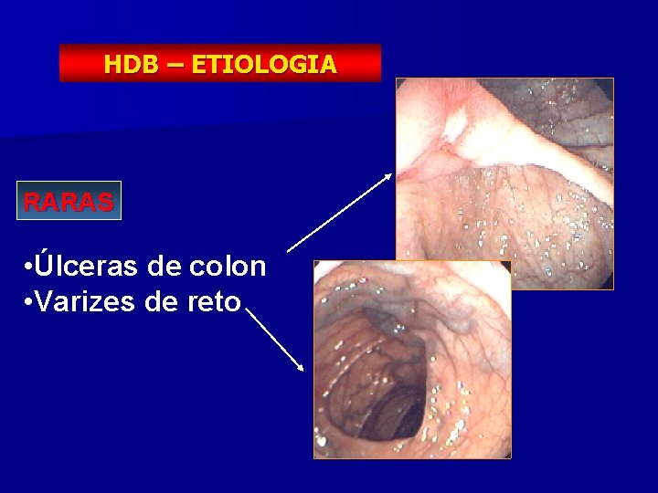 HDB – ETIOLOGIA RARAS • Úlceras de colon • Varizes de reto 