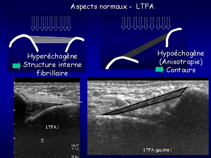Aspects normaux - LTFA Hyperéchogène Structure interne fibrillaire Hypoéchogène (Anisotropie) Contours 