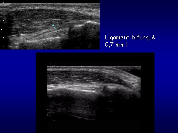 Ligament bifurqué 0, 7 mm ! 