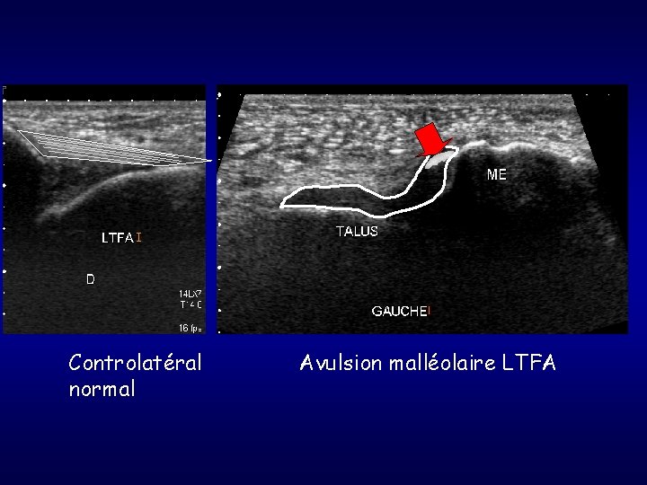 Controlatéral normal Avulsion malléolaire LTFA 