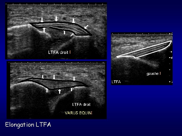 Elongation LTFA 