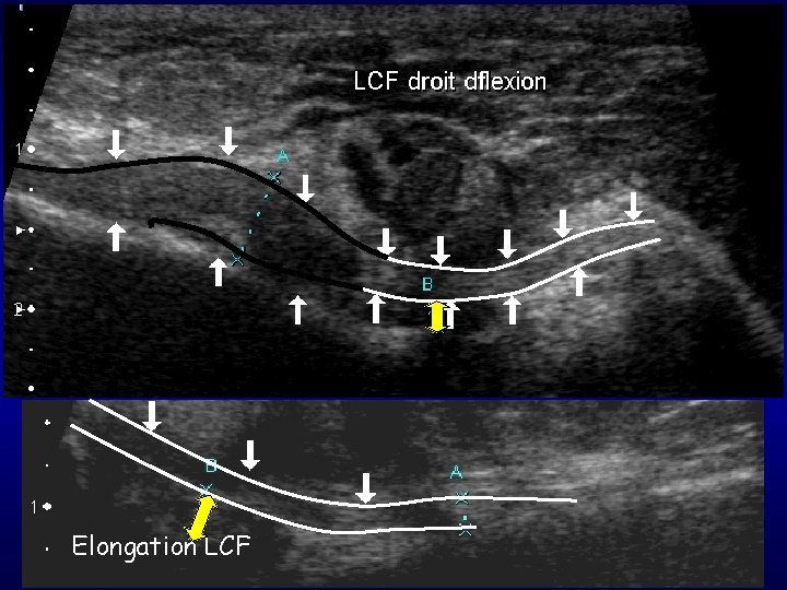 Elongation LCF 