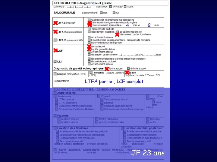 44 2 LTFA partiel, LCF complet JF 23 ans 