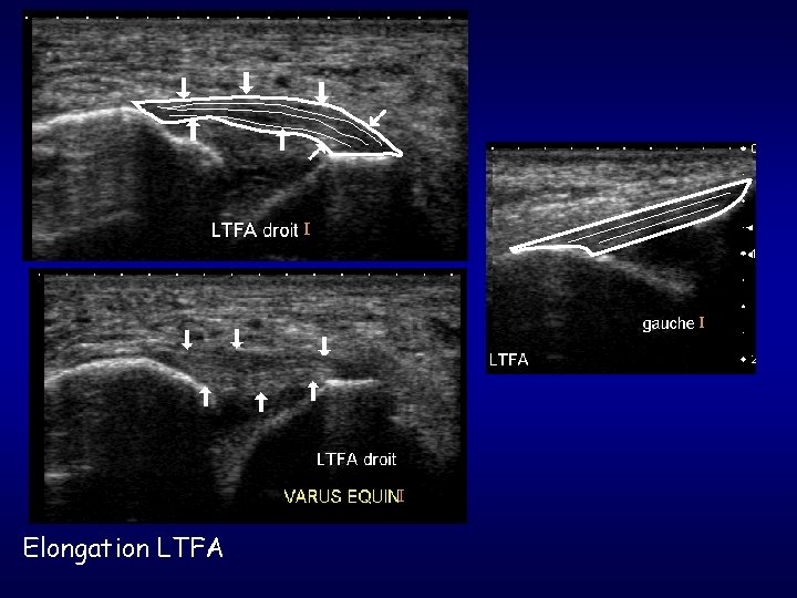 Elongation LTFA 