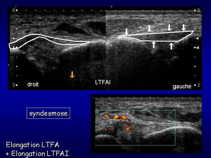 syndesmose Elongation LTFA + Elongation LTFAI 
