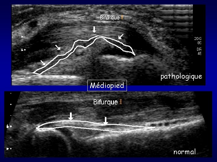 Médiopied pathologique normal 