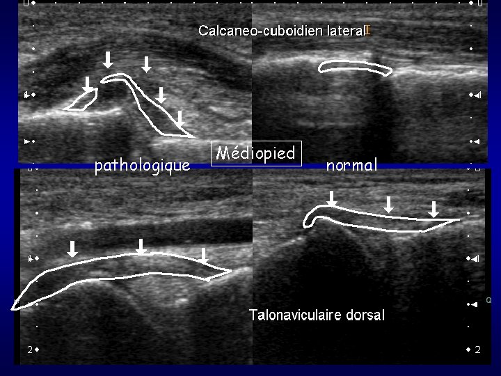 pathologique Médiopied normal 