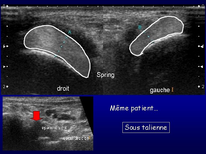 Même patient… Sous talienne 