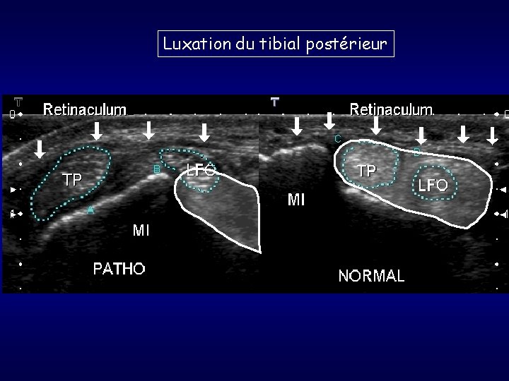 Luxation du tibial postérieur 