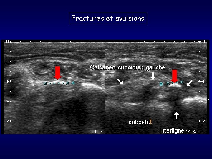 Fractures et avulsions 