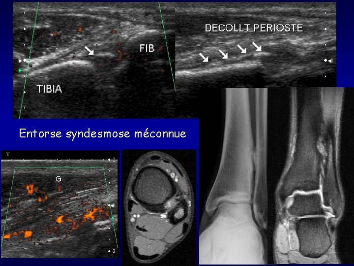 Entorse syndesmose méconnue 
