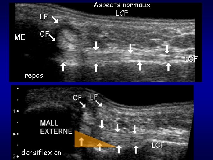 Aspects normaux LCF repos dorsiflexion 