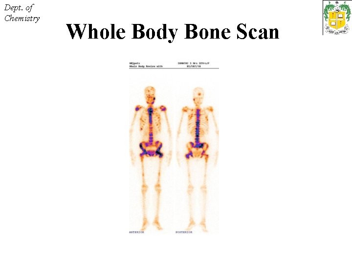 Dept. of Chemistry Whole Body Bone Scan 