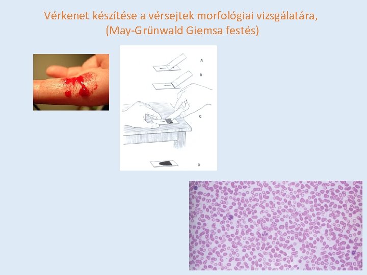Vérkenet készítése a vérsejtek morfológiai vizsgálatára, (May-Grünwald Giemsa festés) 