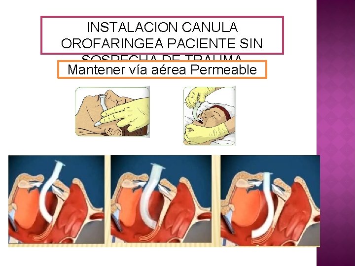 INSTALACION CANULA OROFARINGEA PACIENTE SIN SOSPECHA DE TRAUMA Mantener vía aérea Permeable 