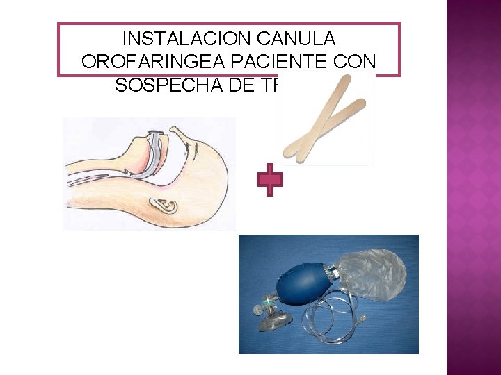 INSTALACION CANULA OROFARINGEA PACIENTE CON SOSPECHA DE TRAUMA 