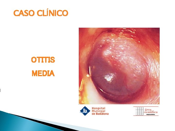 CASO CLÍNICO OTITIS MEDIA 