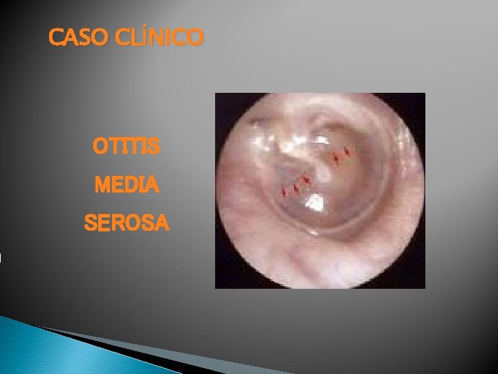 CASO CLÍNICO OTITIS MEDIA SEROSA 