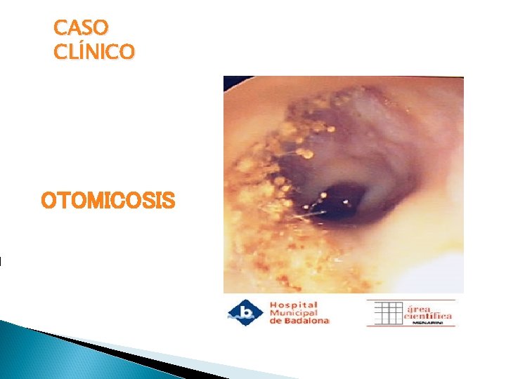 CASO CLÍNICO OTOMICOSIS 