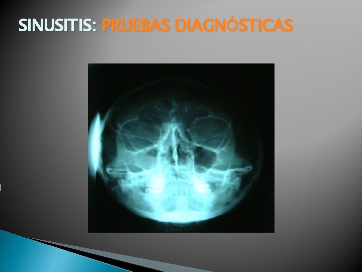 SINUSITIS: PRUEBAS DIAGNÓSTICAS 