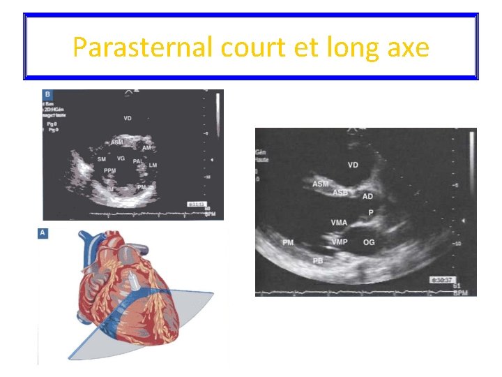 Parasternal court et long axe 