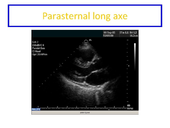 Parasternal long axe 