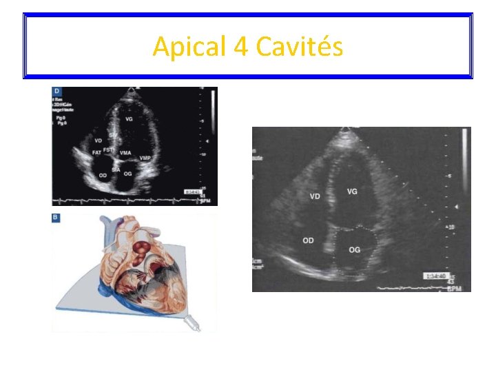 Apical 4 Cavités 