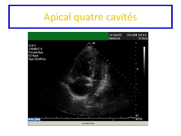 Apical quatre cavités 