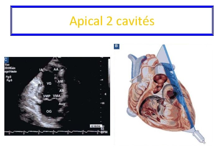 Apical 2 cavités 