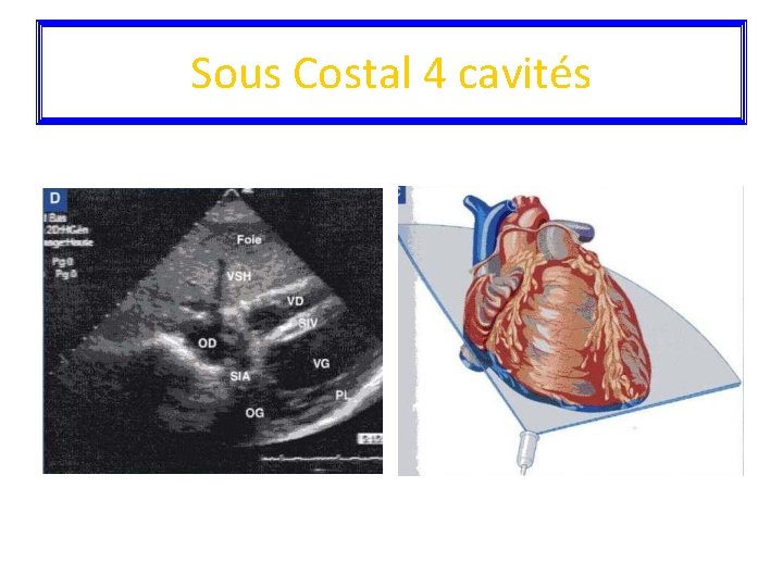 Sous Costal 4 cavités 