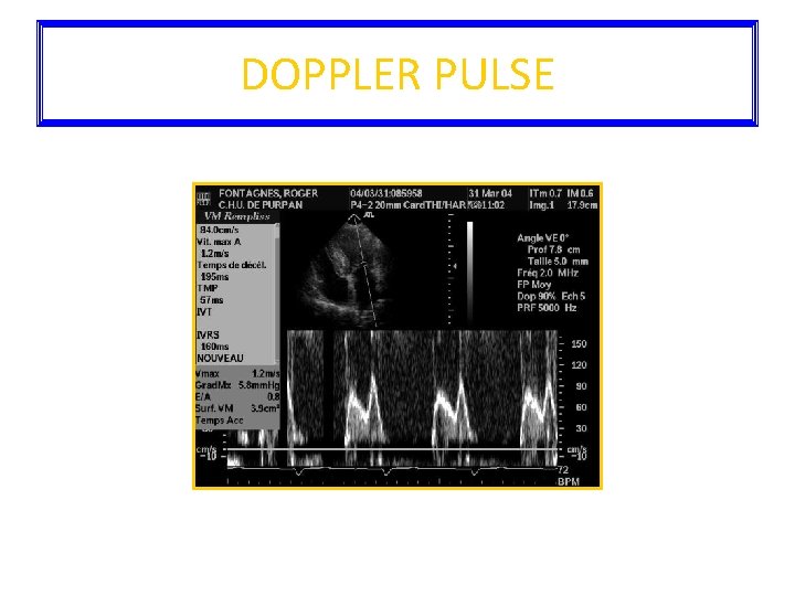 DOPPLER PULSE 