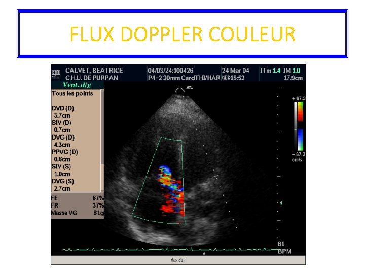 FLUX DOPPLER COULEUR 