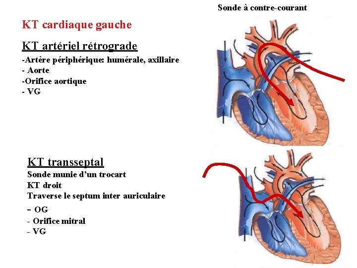 Sonde à contre-courant KT cardiaque gauche KT artériel rétrograde -Artère périphérique: humérale, axillaire -