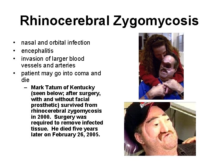 Rhinocerebral Zygomycosis • nasal and orbital infection • encephalitis • invasion of larger blood Rhinocerebral Zygomycosis • nasal and orbital infection • encephalitis • invasion of larger blood