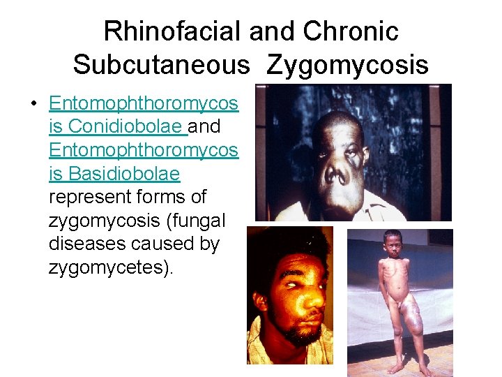 Rhinofacial and Chronic Subcutaneous Zygomycosis • Entomophthoromycos is Conidiobolae and Entomophthoromycos is Basidiobolae represent Rhinofacial and Chronic Subcutaneous Zygomycosis • Entomophthoromycos is Conidiobolae and Entomophthoromycos is Basidiobolae represent