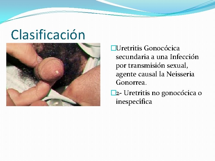 Clasificación �Uretritis Gonoco cica secundaria a una Infeccio n por transmisio n sexual, agente